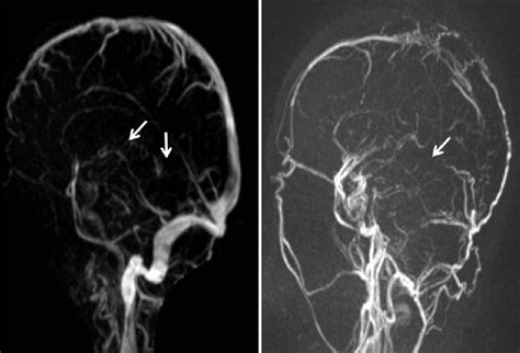 Magnetic Resonance Venography Time Of Flight Images Case 1 And Download Scientific Diagram