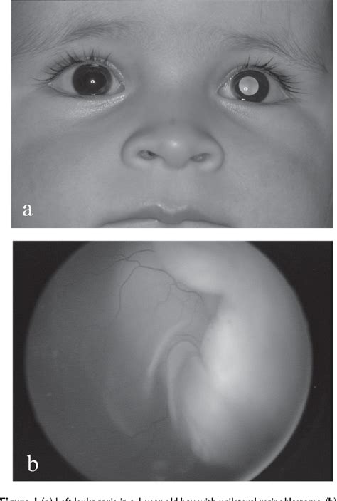 Leukocoria In Infants