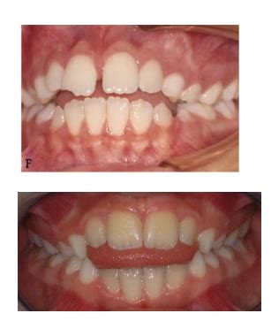 VIAGEM PELA ORTODONTIA Oclusão Normal na Dentição na Permanente