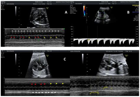 Reprod Med Free Full Text Recurrent Congenital Heart Block Due To Maternal Anti Ro