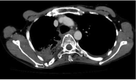 Primary Mediastinal Her2 Positive Apocrine Carcinoma In Mature Teratoma