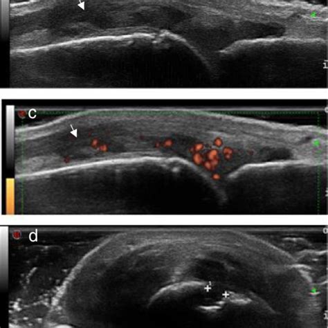 Imagens of a normal MCP joint and an abnormal MCP joint of a RA ...