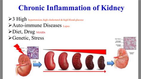 Exclusive: Inflammation of the Kidney ~ Natural Health & Beauty ...