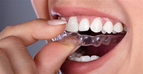 What Is Clear Aligner Therapy Enamel Dentistry