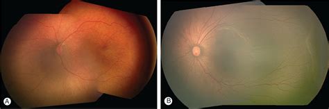 Retinopathy Of Prematurity Pathophysiology And Screening Clinical Tree