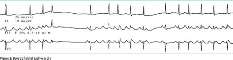 Figure From Catheter Ablation Of Atrial Arrhythmias State Of The Art