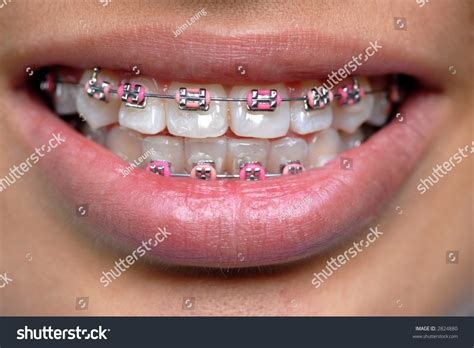 Pink Braces Stock Photo 2824880 Shutterstock