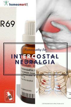 Intercostal neuralgia pain relief