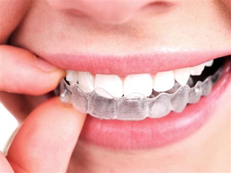 Where To Find Invisalign Dental Treatment Central