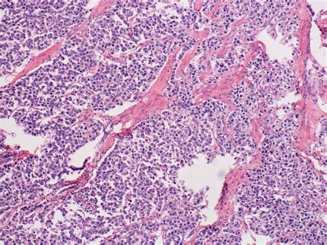 Dysgerminoma Tumor Cells Arranged In Lobules Separated By Fibrous