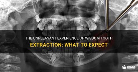 The Unpleasant Experience Of Wisdom Tooth Extraction What To Expect Medshun