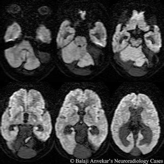 Dr Balaji Anvekar FRCR: Posterior Fossa Arachnoid cyst MRI