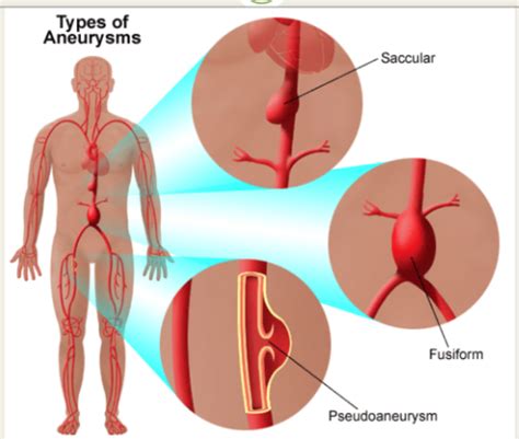 Vascular Disease Flashcards Quizlet