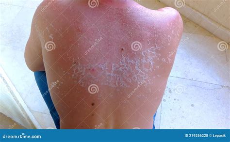 Sunburn On The Back And Neck Of A Man Skin Peeling And Peeling Red