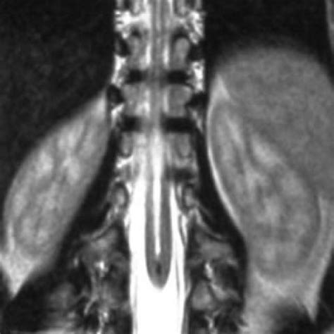 Diastematomyelia | Eurorad