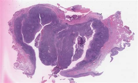 Reactive Follicular And Paracortical Immunoblastic Hyperplasia In Tonsils