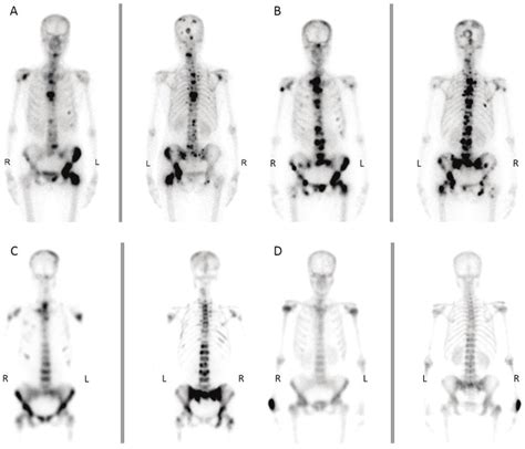 Radionuclide Bone Imaging Scans Demonstrating That The Bone Metastases Download Scientific