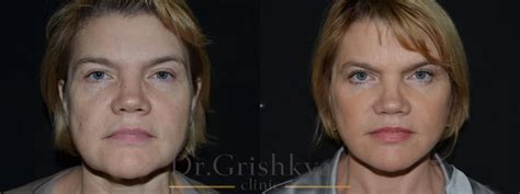 Подтяжка лица и шеи, Cosmetic-clinic в Москве