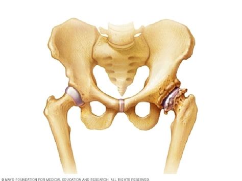 Osteoarthritis Degenerative Joint Disease Definition Osteoarthritis Oa Is