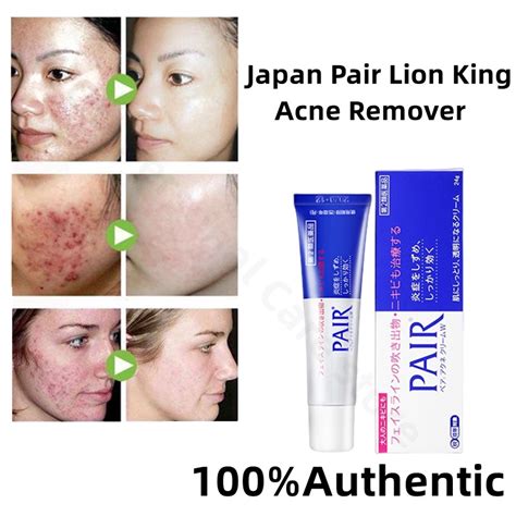 Japan Pair Lion King Acne Remover 24g Facial Acne Cream Pimple Remover Acne Treatment Skin Cream