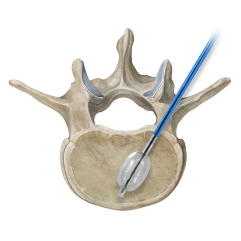 Needle Spine Augmentation System Osteo Site IZI Medical Balloon