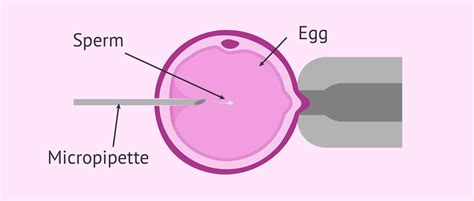 Intracytoplasmic Sperm Injection Icsi