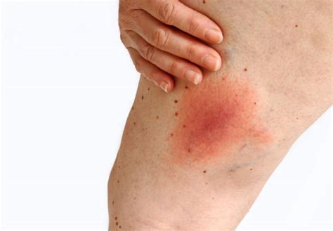 Lyme Disease Rash Stock Photos Pictures And Royalty Free Images Istock