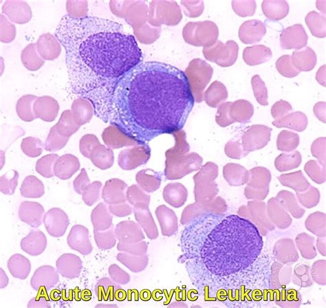 Atypical Lymphocyte Vs Monocyte