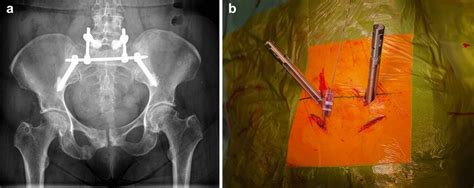 A And B X Ray Pelvic Overview A And Intraoperative Image B Of A