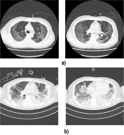 Chest Computed Tomography Ct A Bilateral Ground Glass Opacity With A Download Scientific