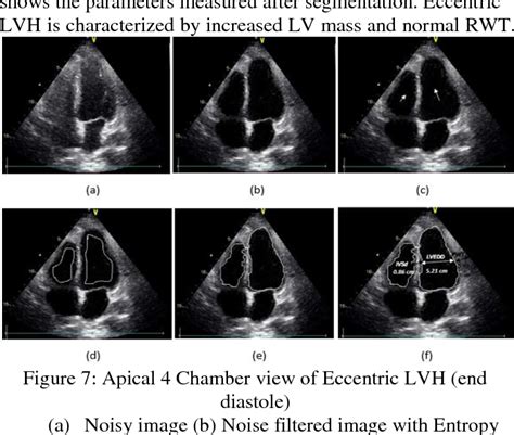 Figure 1 From Quantification Of Left Ventricular Hypertrophy Parameters By Endocardium