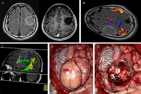 A Case Of Left Middle Frontal Gyrus Low Grade Glioma A T Flair