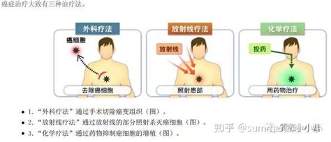 日本不开刀治疗癌症的方法，精准杀死癌细胞 日本医疗 知乎