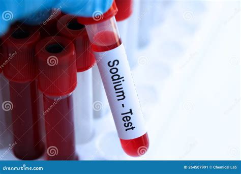 Sodium Test To Look For Abnormalities From Blood Stock Image Image Of