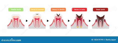 Las Etapas De La Caries Dental Ilustración De Vector Plano Ilustración Del Vector Ilustración