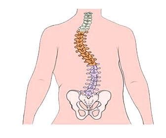 Qué es la escoliosis Causas síntomas diagnóstico y tratamiento