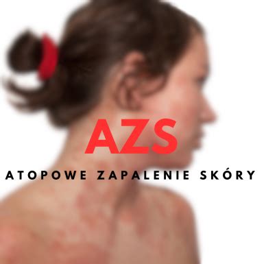 Atopowe zapalenie skóry AZS Przyczyny objawy i domowe sposoby leczenia