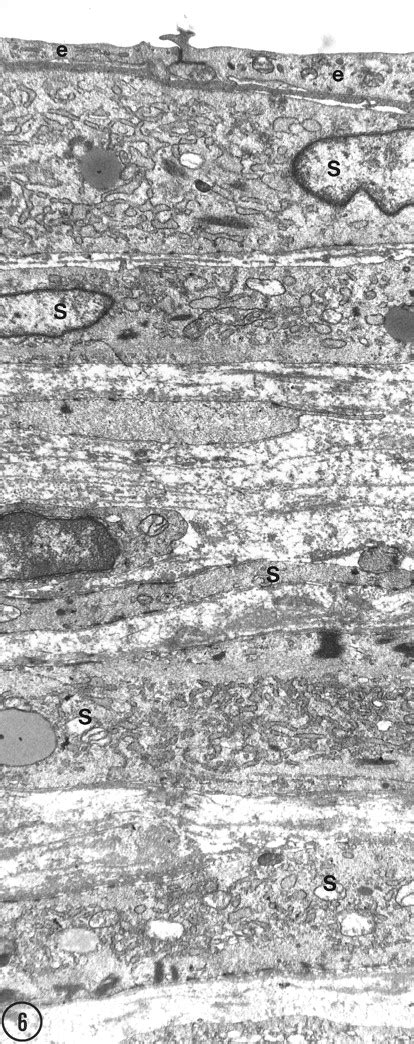 A Definition Of Advanced Types Of Atherosclerotic Lesions And A