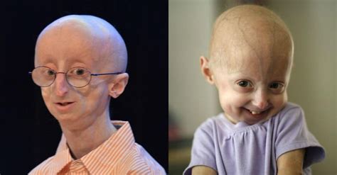 15 Fascinating Facts About Progeria The Rapid Aging Disease