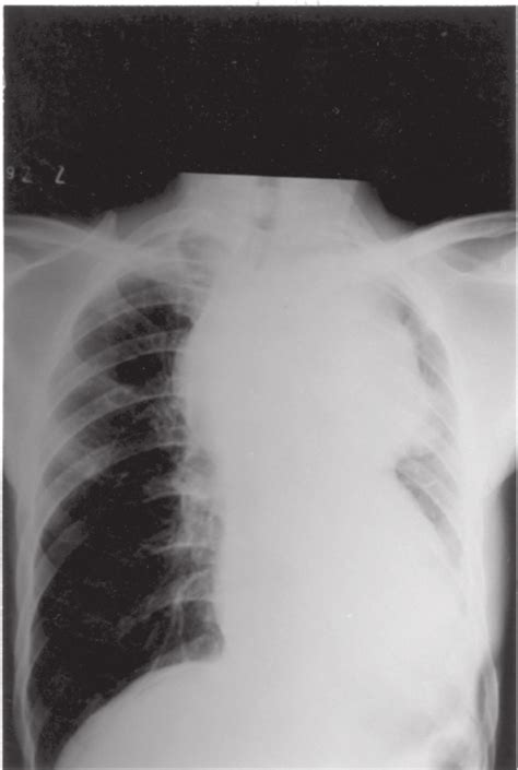 Radiografia Simples De T Rax Revela Grande Alargamento Do