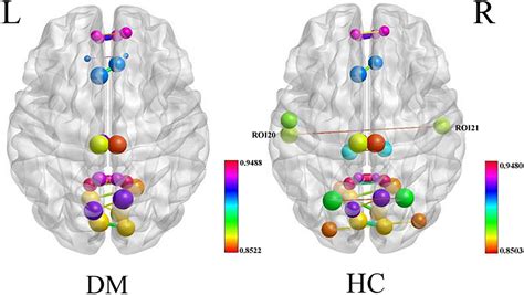 Frontiers Aberrant Brain Functional Networks In Type Diabetes