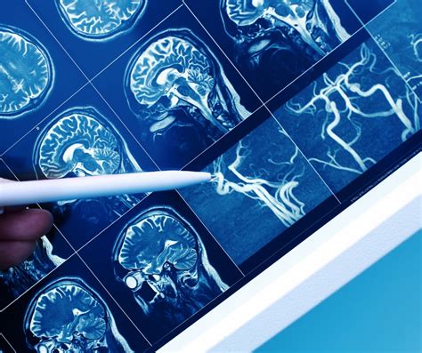 Cerebrovascular Disease In 1467 Participants Racial