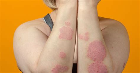 Understanding Psoriasis Types And Triggers Bldg Active