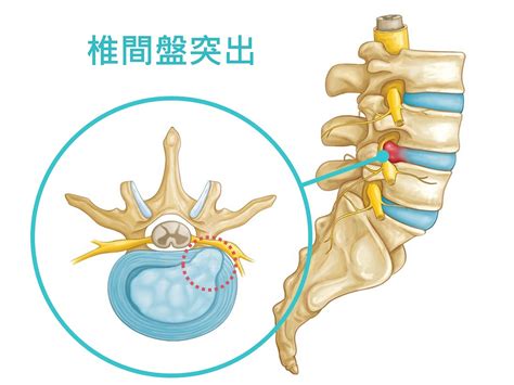 椎間盤突出症狀詳解！腰痛、背痛治療10大疑問彙整 何琨棟醫師 Dr Aiden