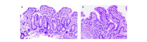 Histopathology Findings In Patient 1 A Duodenal Mucosa With Total