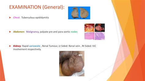 Inguinoscrotal Swelling Ppt