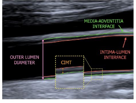 B Mode Ultrasound Image Of The Common Carotid Artery Longitudinal