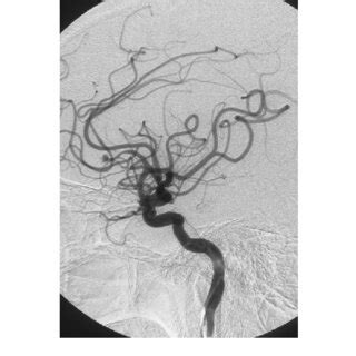 Case 3 Left Left And Right Right Internal Carotid Angiograms