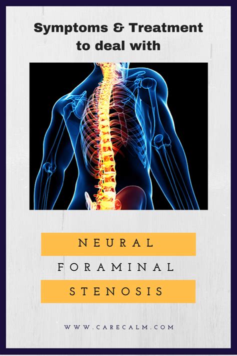 neural foraminal stenosis symptoms treatment healthy lifestyle tips