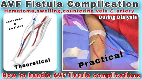 Av Fistula Needling Complication During Hemodialysis Youtube